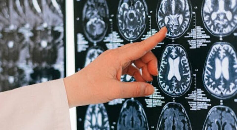 Long-Term Impact of Traumatic Brain Injuries from Car Accidents and How to Cope