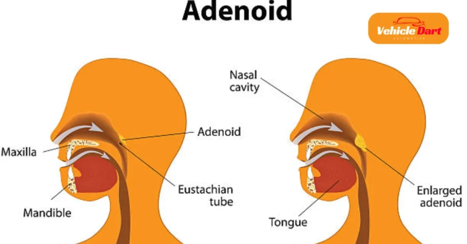 adenoidid